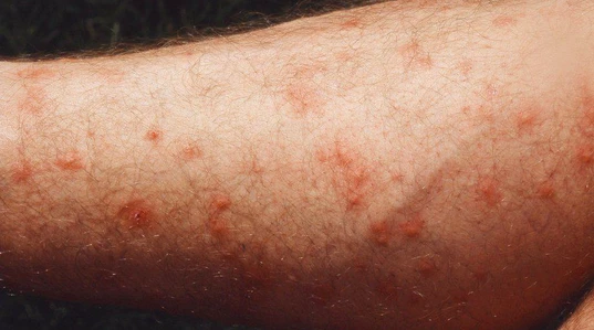 Midges bites on arm